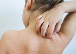 Корь - новая пандемия? Как геленджичанам уберечь себя от болезни