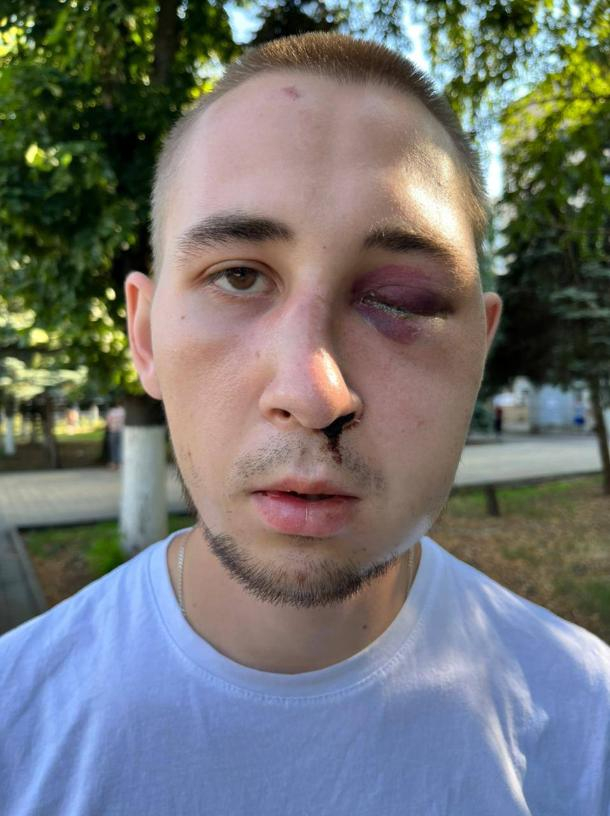 «У меня глаз вытек»: летом в Геленджике избили мужчину, а виновный до сих пор не понес наказания