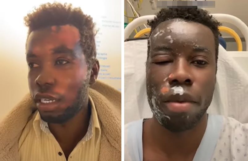 В Швейцарии негру сожгли лицо за поддержку Украины